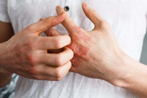 Mani di una persona affetta da dermatite.
