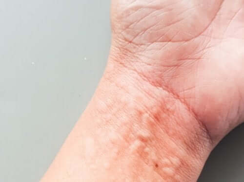 Orticaria cronica: come incide sulla qualità della vita?