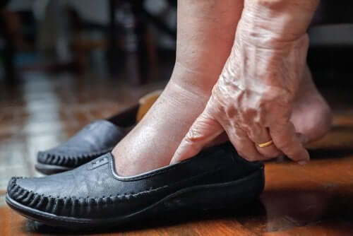 Gambe gonfie per il caldo: misure preventive