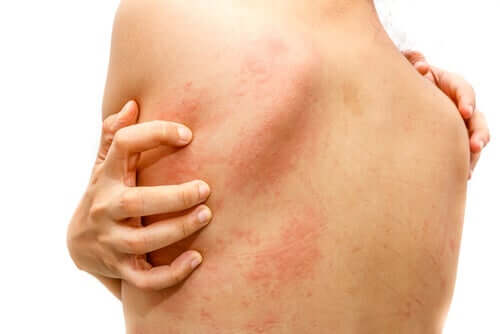 Rimedi fai da te per la orticaria.
