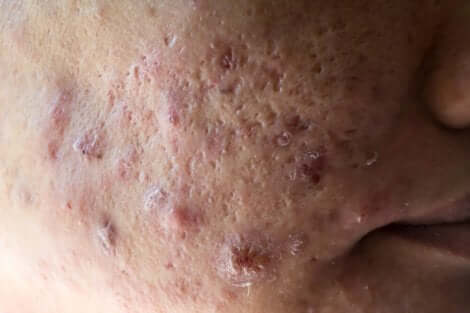 Cicatrici da acne sul viso.