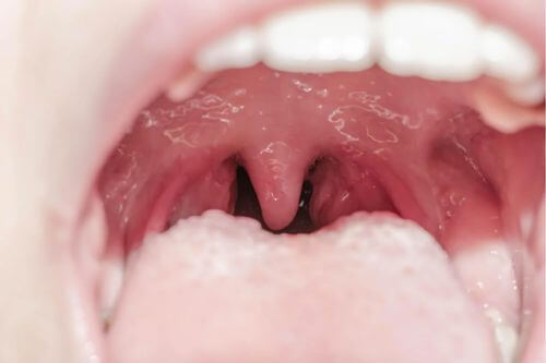 Uvulite.