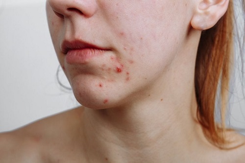 Relazione tra dieta e acne: cosa dice la scienza?