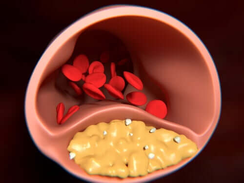 Arteriosclerosi nelle vene.