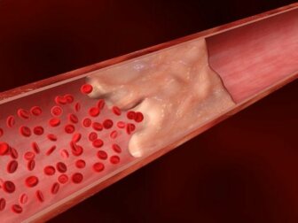 Calcio nelle arterie e malattie cardiovascolari