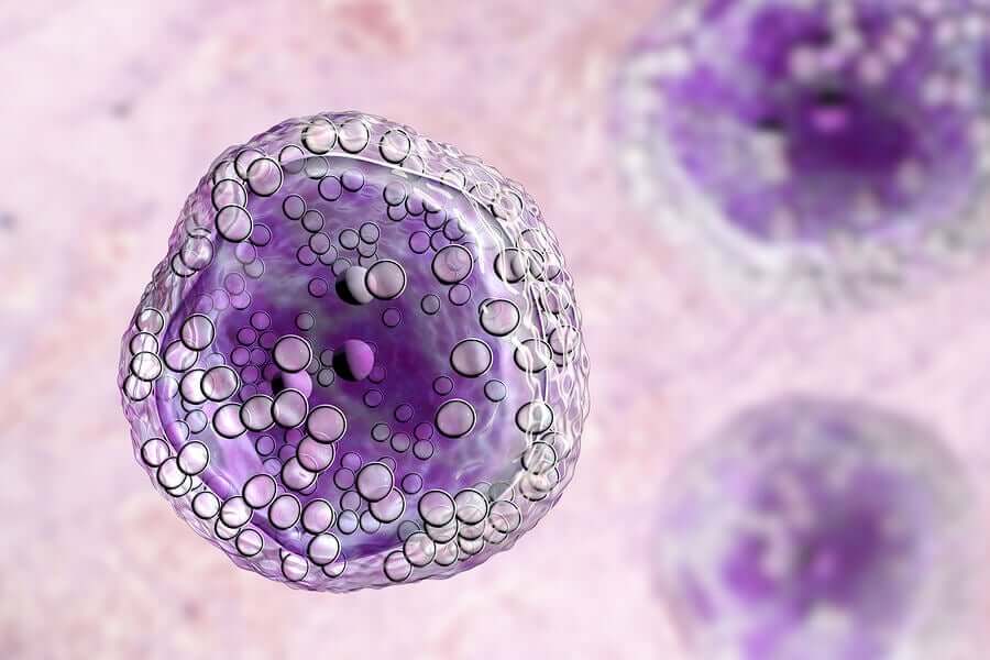 Cellule del linfoma.