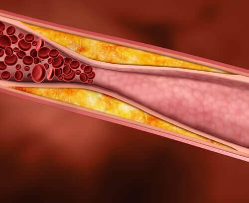 Colesterolo cattivo nelle arterie.