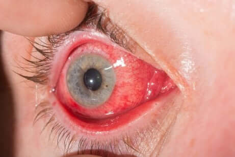 Congiuntivite allergica.