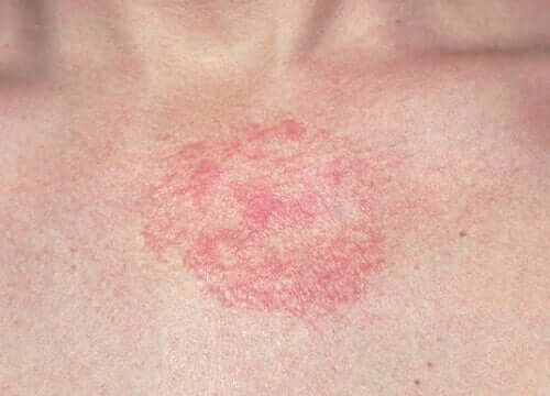 Dermatite irritazione.