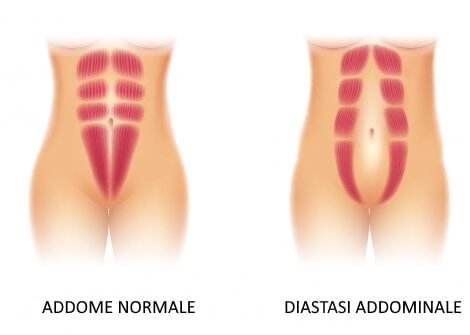 Addome normale e diastasi addominale.