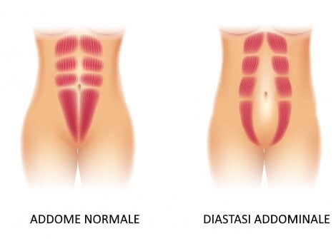 Addome normale e diastasi addominale.