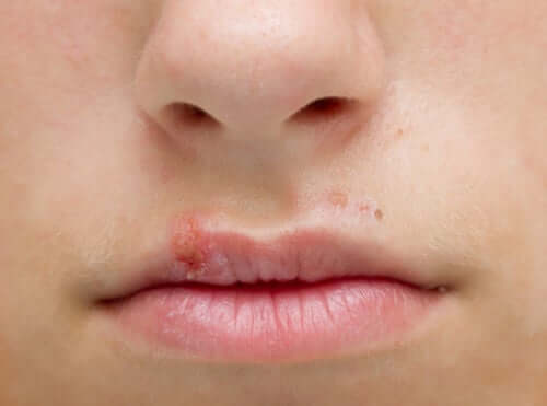 Herpes labiale.