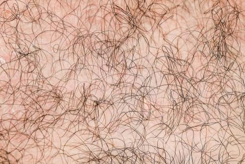 Ipertricosi: la sindrome del lupo mannaro