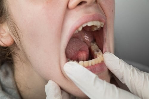 Tumore del cavo orale: fattori di rischio