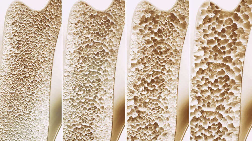 Ossa con osteoporosi.