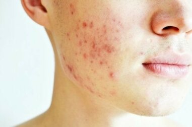 Acne nodulo-cistica: cause e trattamento