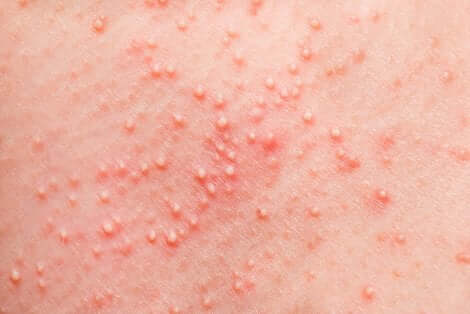 Reazione cutanea allergica.