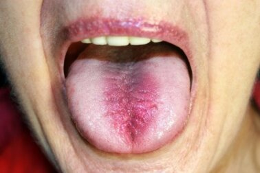 Sindrome della bocca urente: sintomi e cause