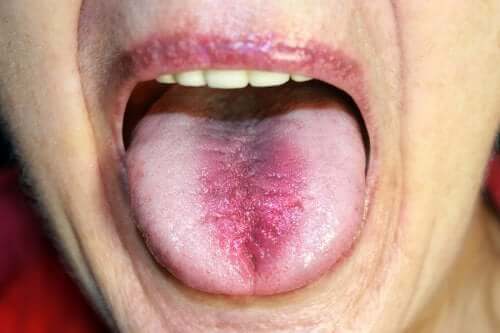 Sindrome della bocca urente: sintomi e cause