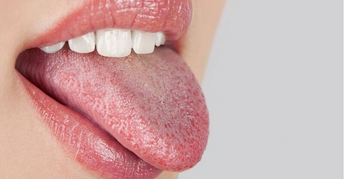 La sindrome della bocca urente.