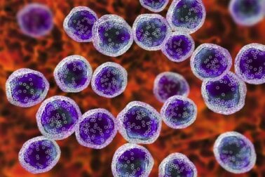 Sindrome di Sézary: cause e trattamenti