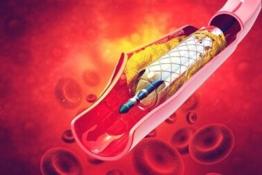 Stent: com'è fatto e a cosa serve?