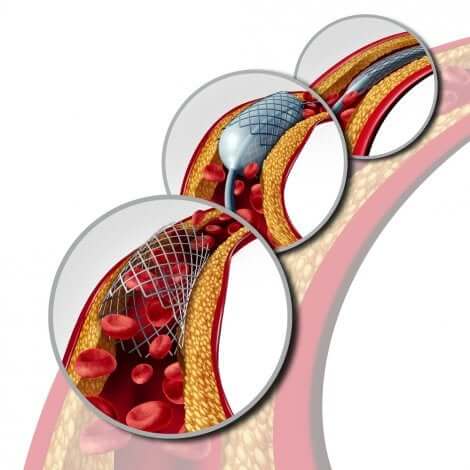 Stent e arteria con aterosclerosi.