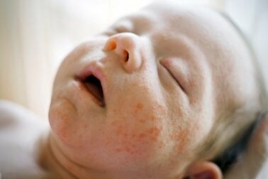 Sudamina o miliaria: di cosa si tratta?