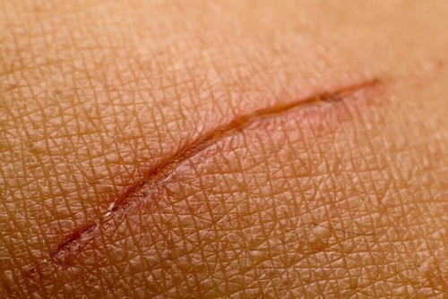 Una cicatrice sulla pelle.