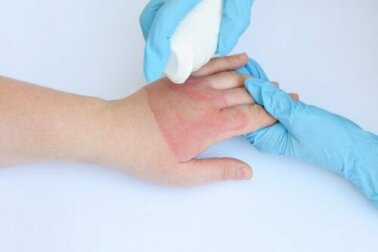 Ustioni da vapore e da acqua calda: trattamenti e consigli