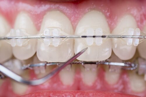 Apparecchio per i denti.