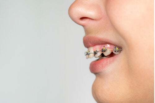La malocclusione dentale: cos'è e come si cura?