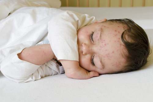 Bambino con la varicella.