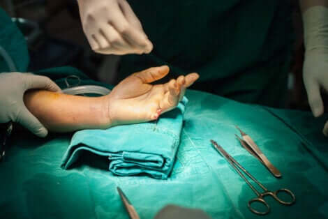 Amputazione accidentale del dito: paziente in sala chirurgica.