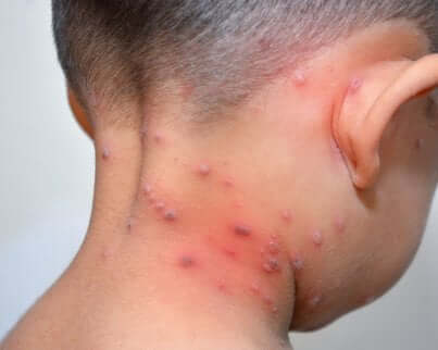 Collo bambino con vesciche.
