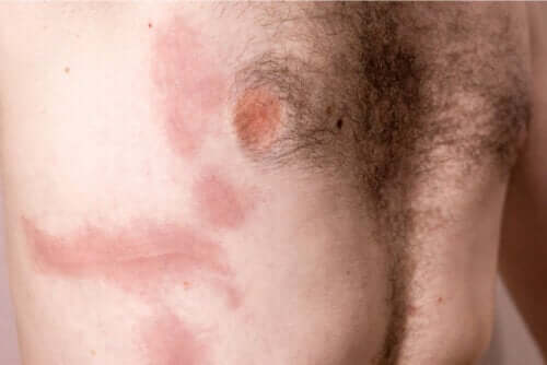 Contusione delle costole: cause, sintomi e trattamento