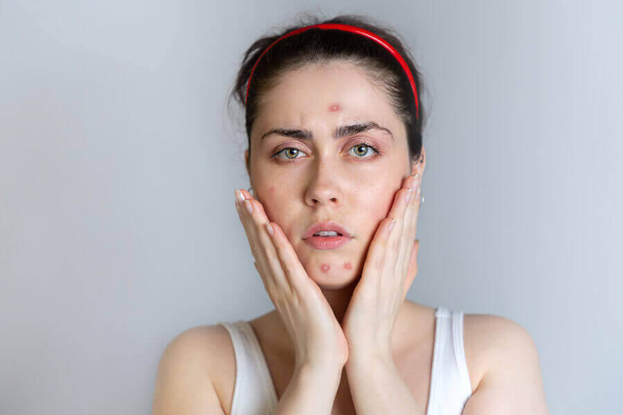 Donna con acne sul viso.