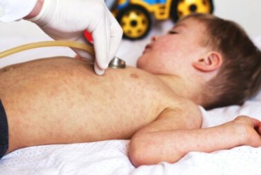 Sindrome della cute ustionata: cause e sintomi