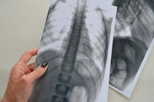 Radiografia lombare: devo preoccuparmi?
