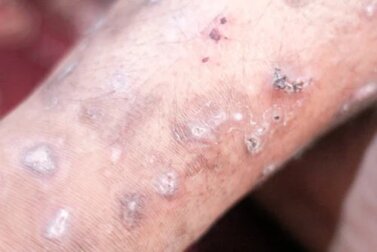 Scabbia nell'uomo: cause, sintomi e trattamenti