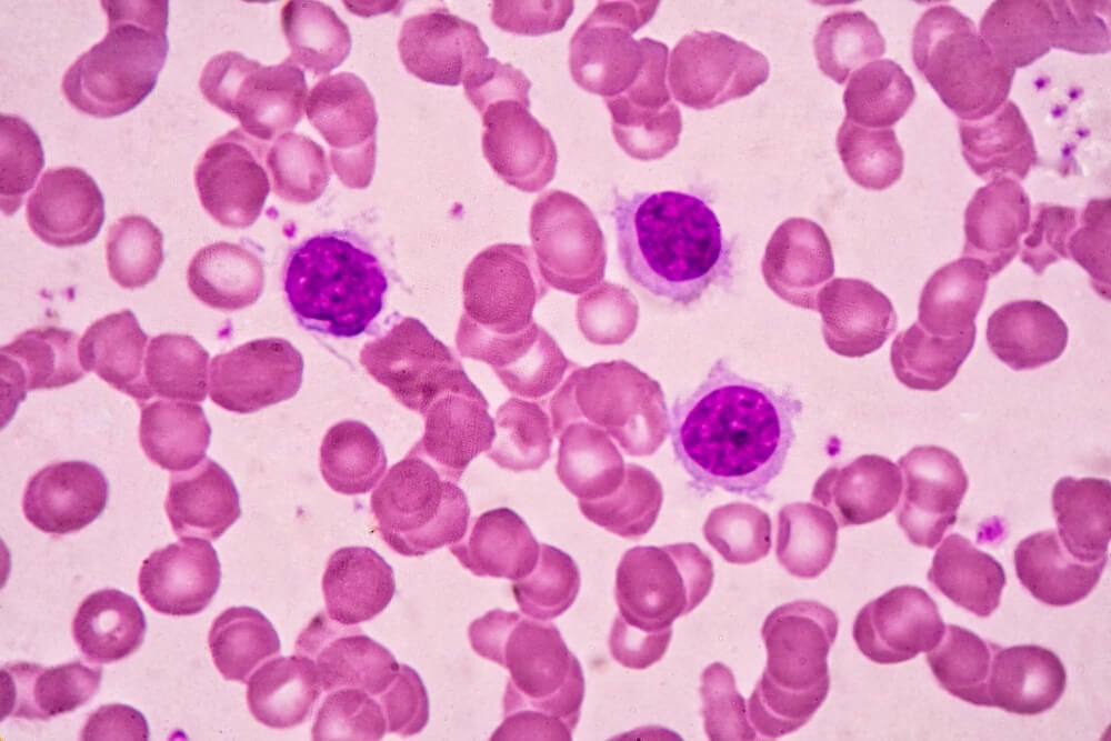 Linfoma o leucemia.