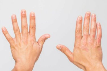 Malattie autoinfiammatorie: di cosa si tratta?