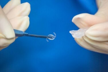 Sostituzione del cristallino: quando è necessaria?