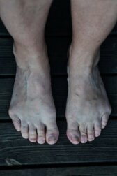 Bunionette o dito del sarto: che cos'è?