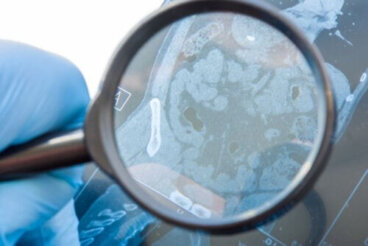 Fistole gastrointestinali: definizione e cause