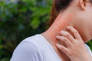 Dermatite e corticosteroidi: quale legame?