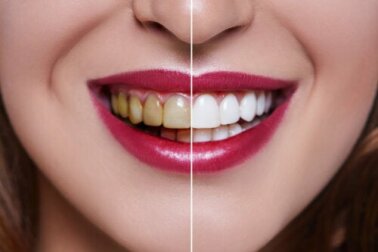 Denti macchiati: quali sono le cause?