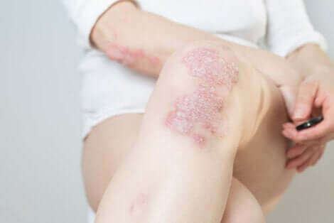 Donna con psoriasi sulle ginocchia.