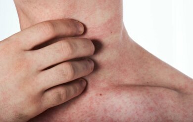 Gli antistaminici: a cosa servono?