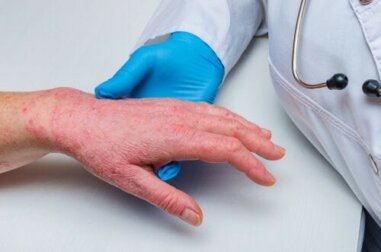 Psoriasi e malattia coronarica: sono in relazione?